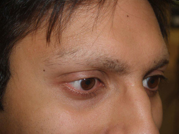 Madarosis - A Condition That Causes Hair Loss of Eyelashes and Eyebrows |  RRMCH