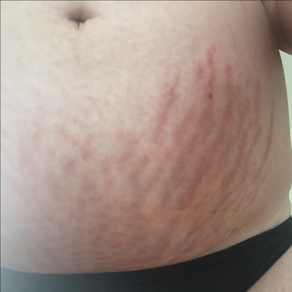 Plaques of Pregnancy or Puppp